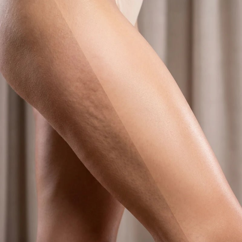 Cellulite : peut-elle vraiment DISPARAÎTRE complètement ? La réponse honnête
